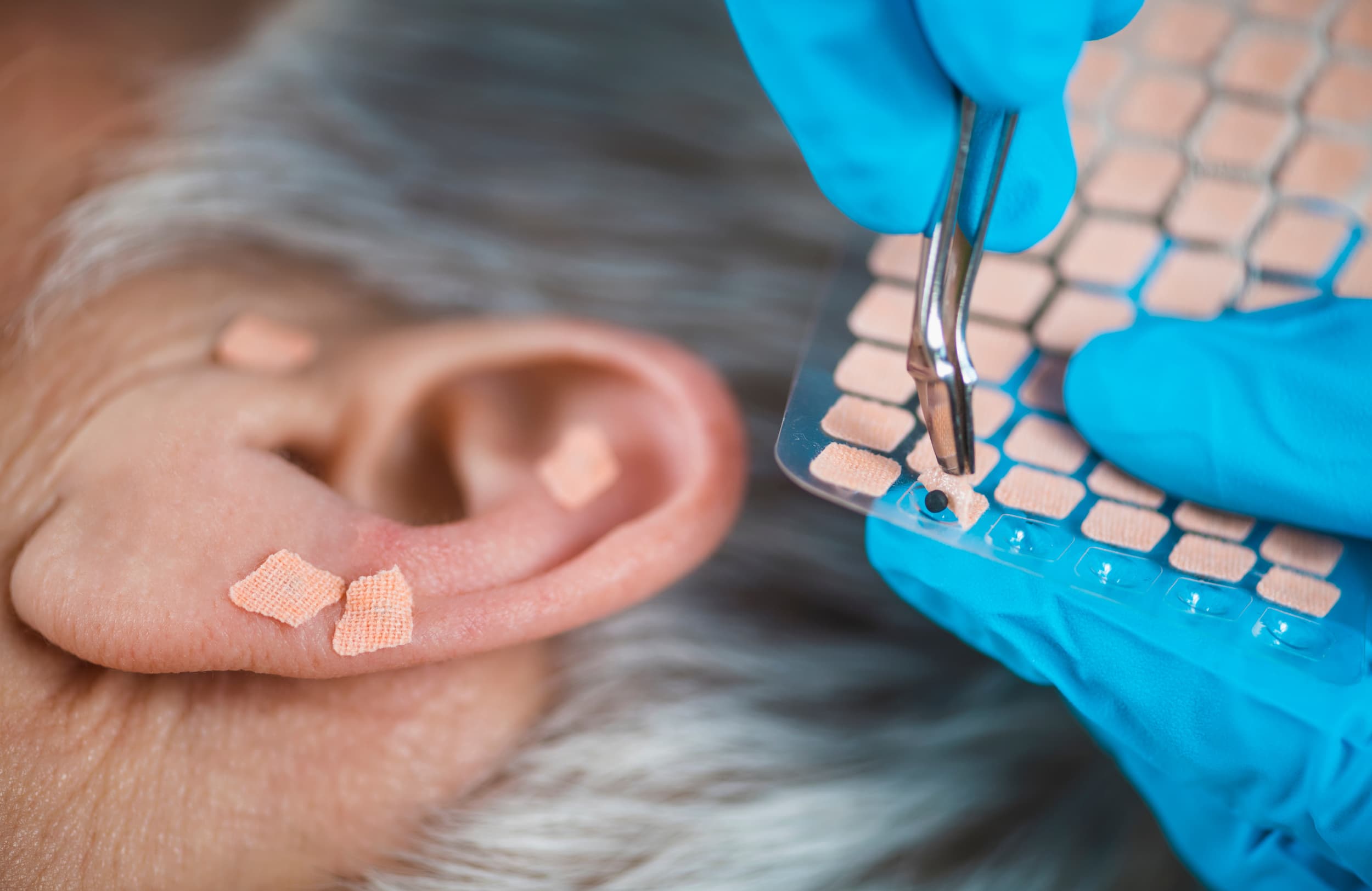Auricular Therapy