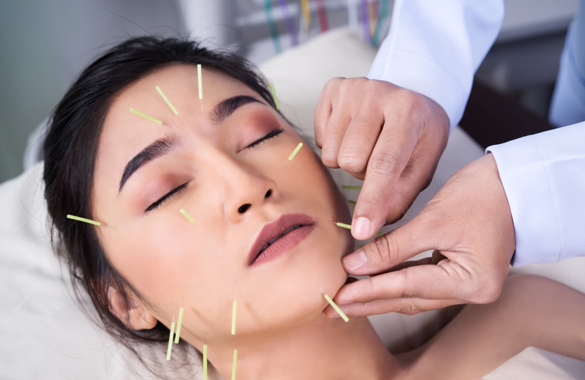 Facial Rejuvenation Acupuncture