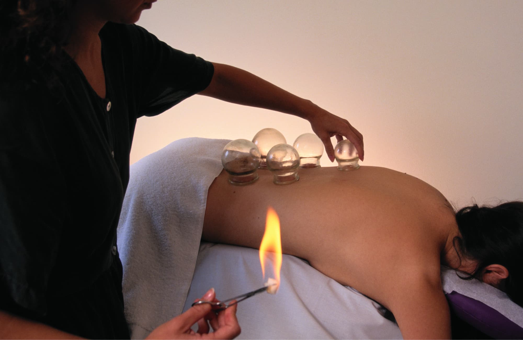 Fire Cupping Therapy