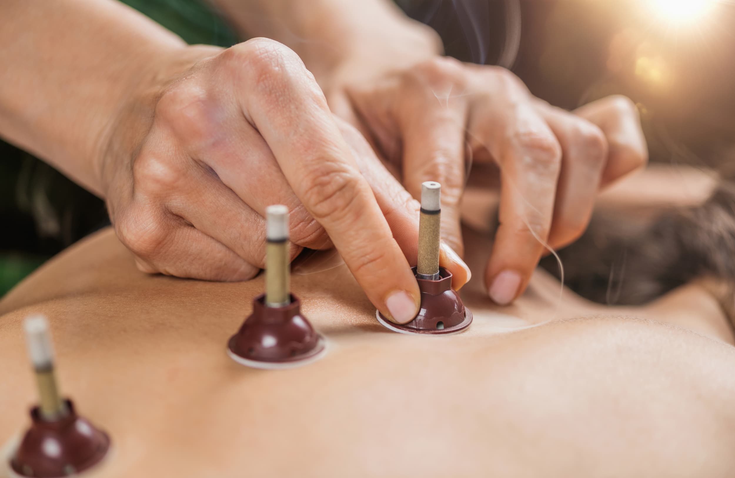 Moxibustion (Moxa)